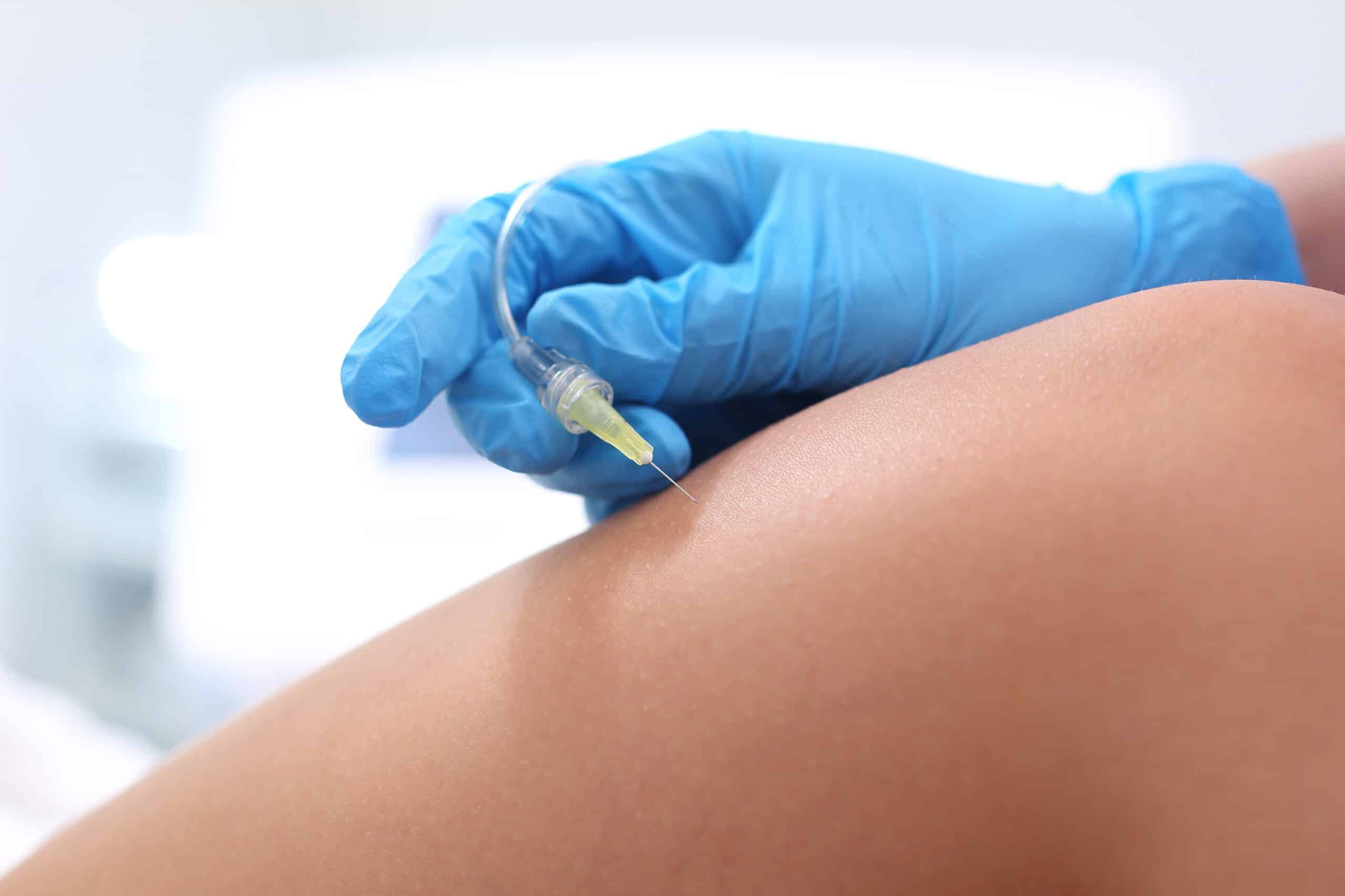 Karboksyterapia — terapia dwutlenkiem węgla dla pięknej skóry
